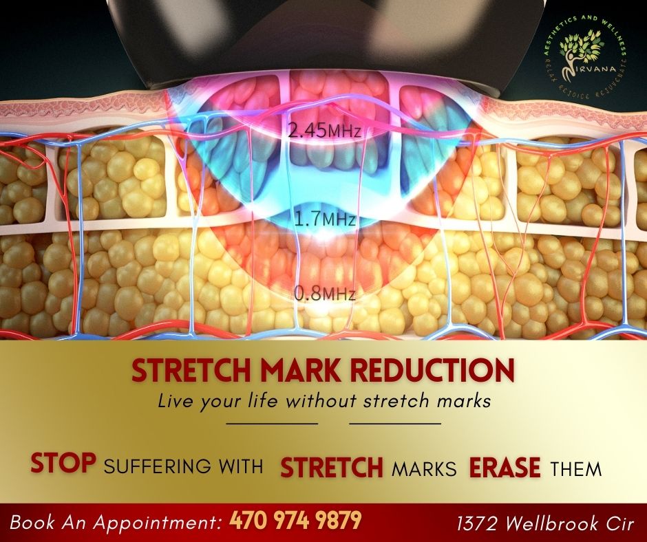 nirvanaconyers's tweet photo. Are you looking to reduce the appearance of stretch marks? 
https://t.co/UR853xg6Y5
☎️ (470)- 974-9879
📍 1372 Wellbrook Cir NE Conyers, GA 30012
📍 5447 Dividend Dr Lithonia, GA 30058
https://t.co/ReXhjTuqOY https://t.co/5KQnkoqJEX