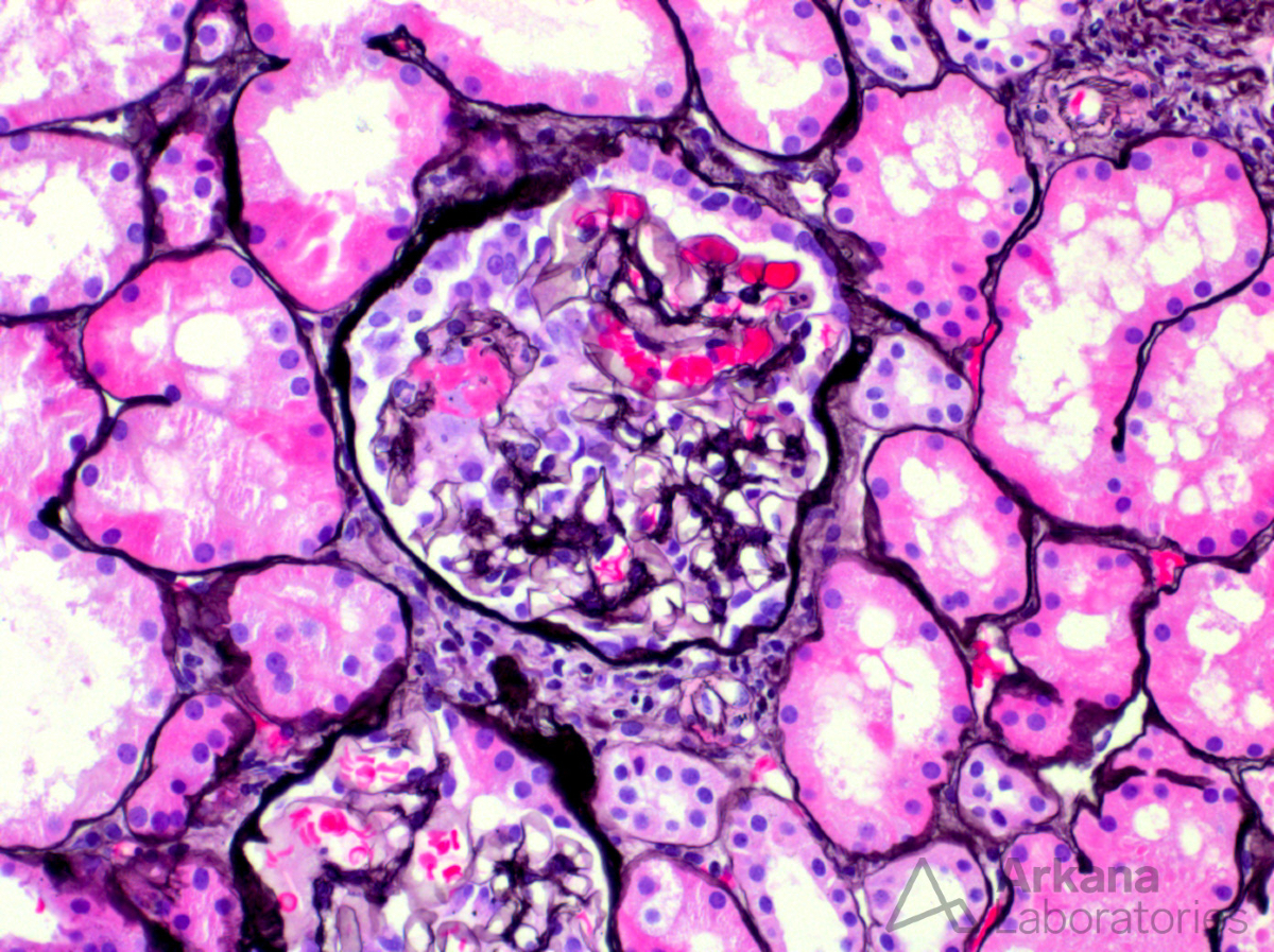 arkanalabs's tweet image. A limited sample showed this lesion and negative staining on paraffin-retrieved IF tissue. What is your diagnosis?

#DiagnoseThis #renalpath #nephropath
