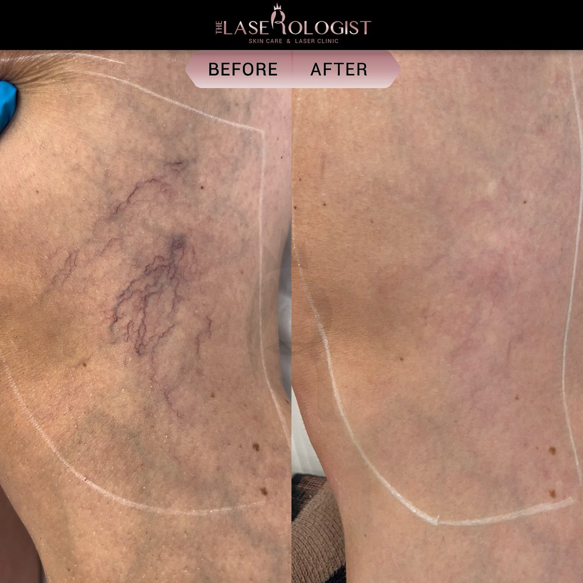CandelaMedical1's tweet image. We&apos;re thrilled to see this fabulous result by the &apos;Laserologist&apos;, achieved using the Nordlys™ to treat his patient&apos;s spider veins present on their leg...
Treatment was carried out using the Nordlys™ NdYAG 1064
Great outcome!
#InnovationInAesthetics #AdvancedTechnology #Nordlys