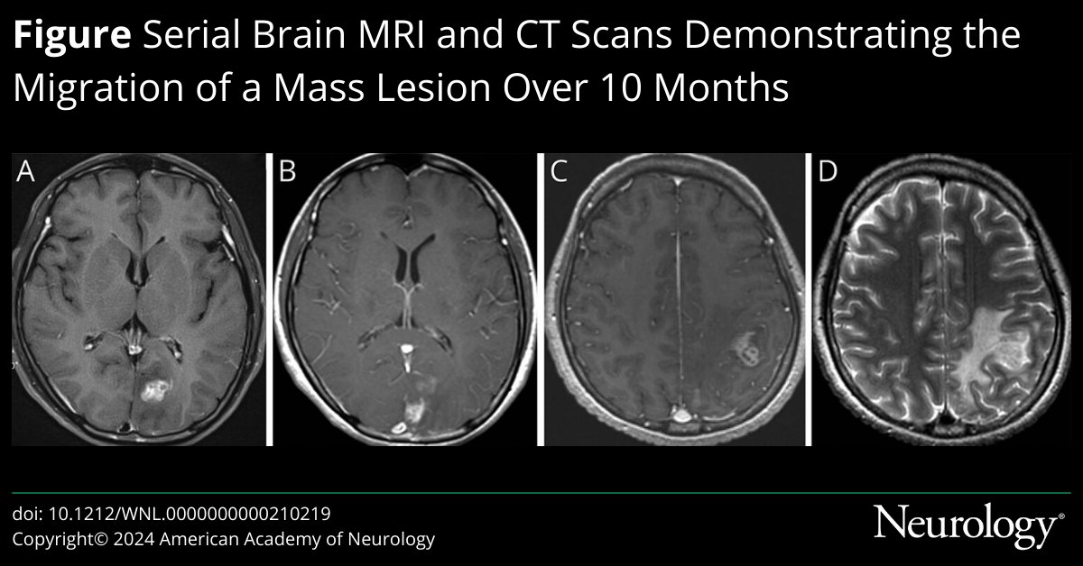 Neurology Journal (@greenjournal) on Twitter photo Video NeuroImage: Sparganosis of the Brain bit.ly/402ZHty
#NeuroTwitter #NeuroX Video NeuroImage: Sparganosis of the Brain bit.ly/402ZHty
#NeuroTwitter #NeuroX