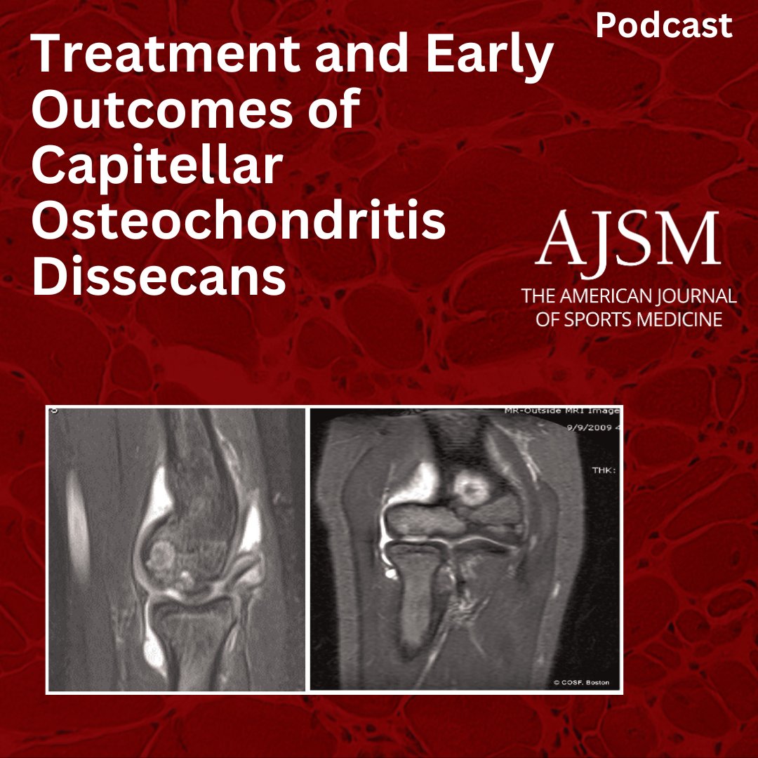 aossmjournals's tweet image. 🦴 Best Approach for Capitellar OCD? 

A new study in The AJSM explores surgical outcomes for osteochondritis dissecans (OCD) of the humeral capitellum, focusing on subchondral bone involvement. ow.ly/kwfs50UtnrV 

#elbow @BostonChildrens