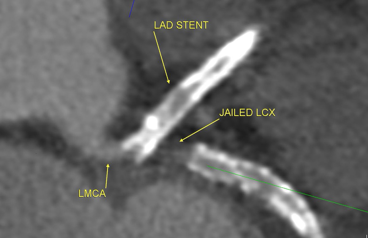 Jailed LCX
<a href="/Heart_SCCT/">Heart_SCCT</a> 
<a href="/TLHM_MD/">Tan-Lucien Mohammed, MD, FACR</a>