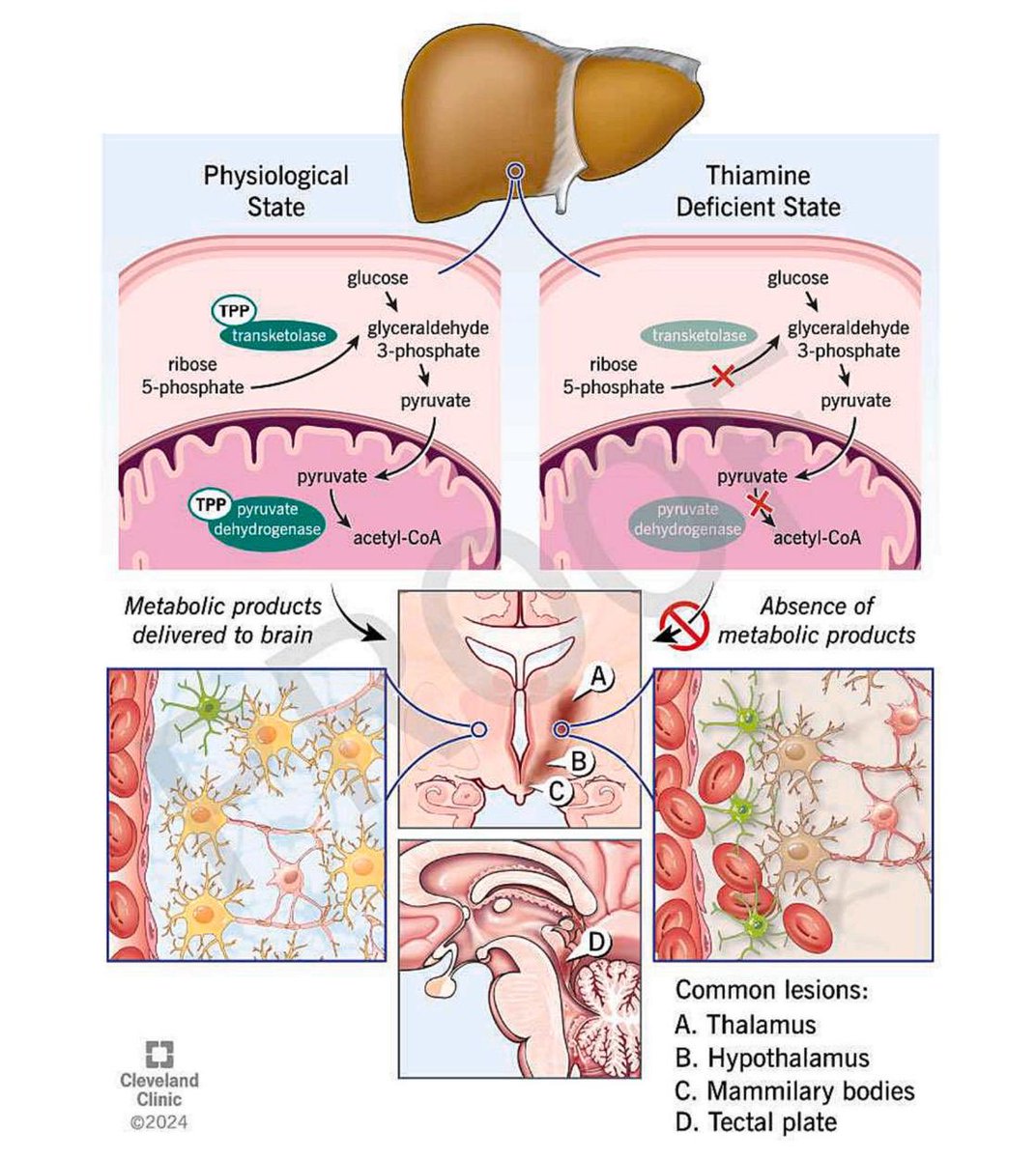 Wernicke

10-20% do not have a hx of🍺use

Triad (1/3 of pts)
⭐️AMS
⭐️👀 nystagmus (horizontal>vertical), lateral rectus palsy
⭐️Ataxia: truncal/gait ataxia 

MRI (53% sens.)
⭐️Thalamus>Mammillary bodies>Midbrain

🩸Thiamine levels are insensitive (does not reflect tissue levels)