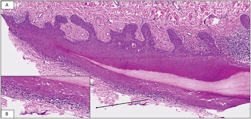 AJDP_Journal's tweet photo. #WhatsNewInDermpath
Histopathologic perspective of nail lichen planus: common features included acanthosis (88%), lichenoid lymphocytic inflammation (96%), and hypergranulosis (72%).
https://t.co/herAcYgwhh https://t.co/qMY6873jAU