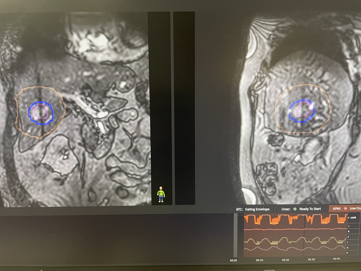 Chad Tang, MD (@chadtangmd) on Twitter photo Huge step forward as we completed the first MRI-gated breathhold sbrt treatment at <a href="/MDAndersonNews/">MD Anderson Cancer Center</a> using the <a href="/Elekta/">Elekta</a> Unity MRL. Real time MRI obtained 5x per second allowed the patient to see their own anatomy. Shoutout to <a href="/JinzhongYangPhD/">Jinzhong Yang</a> and the MRL team for making it happen. Huge step forward as we completed the first MRI-gated breathhold sbrt treatment at <a href="/MDAndersonNews/">MD Anderson Cancer Center</a> using the <a href="/Elekta/">Elekta</a> Unity MRL. Real time MRI obtained 5x per second allowed the patient to see their own anatomy. Shoutout to <a href="/JinzhongYangPhD/">Jinzhong Yang</a> and the MRL team for making it happen.