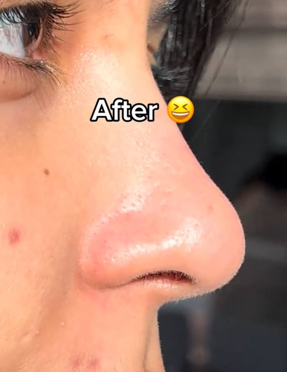 bckupacc99's tweet photo. Aku kagum betul dengan skincare korea. Dia sapu sekali je benda ni terus bersih hidung dia. Clogged pores tu yang jadi penyebab kulit muka tak smooth 😮‍💨 https://t.co/pcMbeKNpFZ