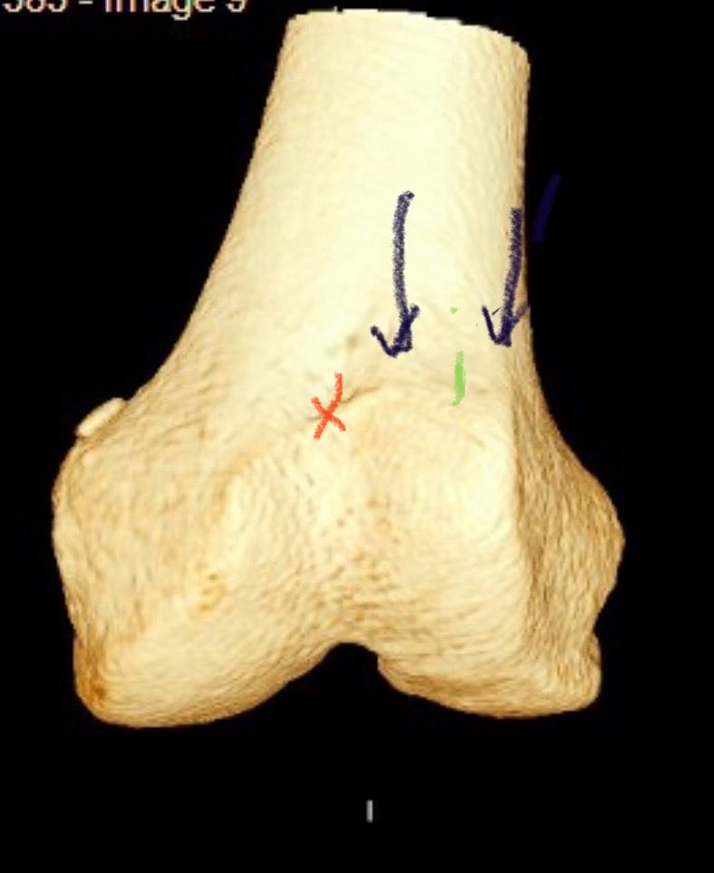 Once you understand 3D, you will know that the patella enters between the medial and lateral ridge ends (green). Makes all the difference in your surgical planning