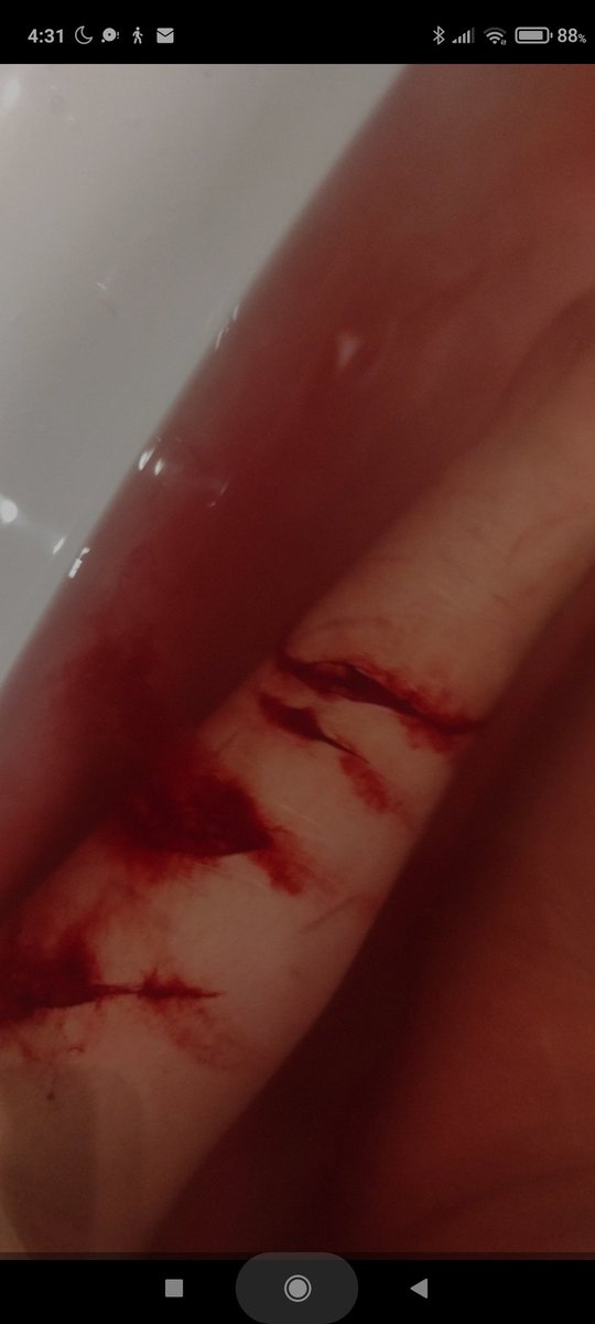 cicatemeto's tweet photo. then had my last recent relapse, one fascia the rest beans https://t.co/DT3e3qXXwU