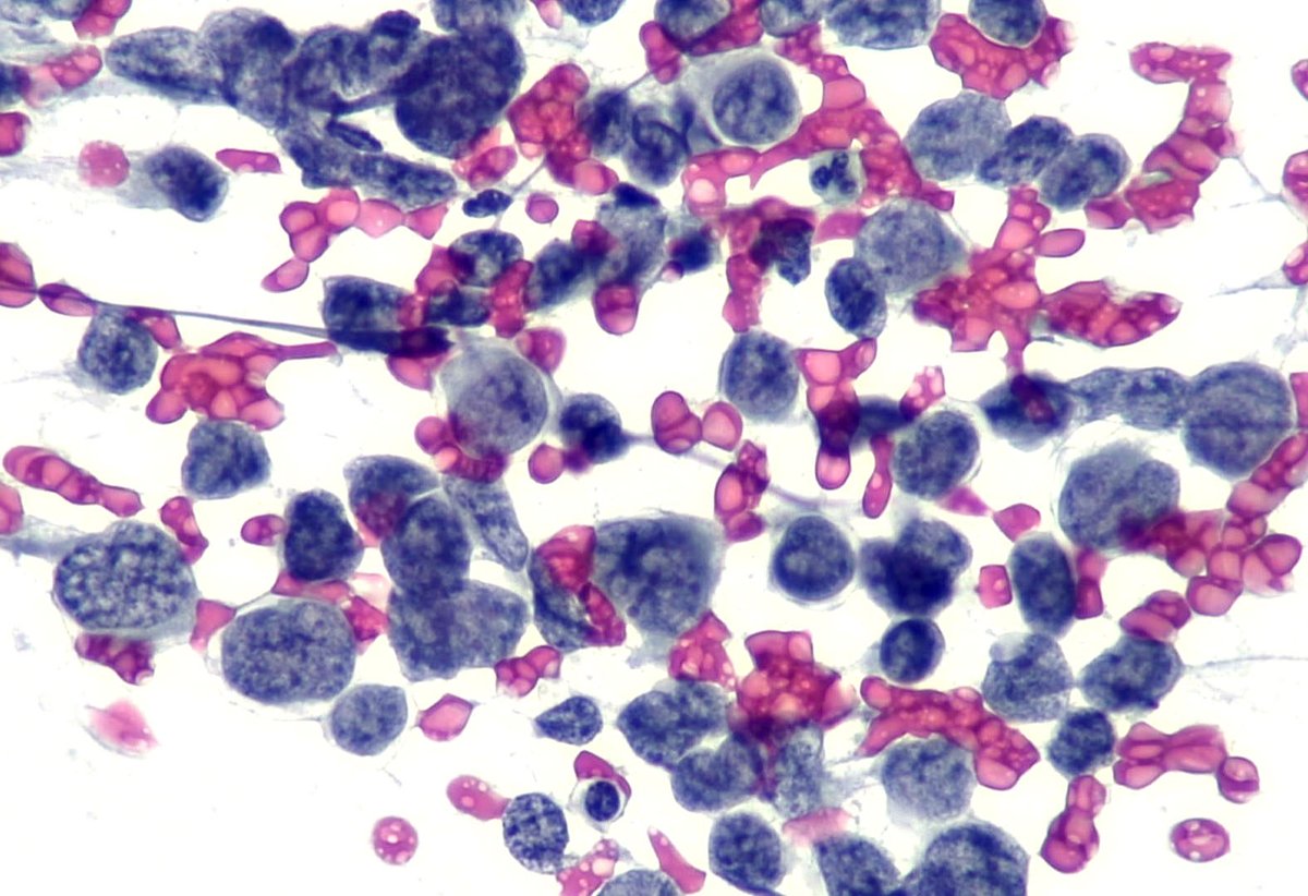 mdlozanoe's tweet photo. An awesome case to start 2025
71M, retroperitoneal mass/adenopathy. No other lesions.
Round cells of intermediate size, 
Scant cytoplasm, 
Clumped chromatin, 
Very isolated nucleoli, mitosis.
What do you think? 🤔🤔
@SECitologia @IACytology @CytologyEFCS @aakasharmand   @mtsiddi https://t.co/IE7wlf68xW