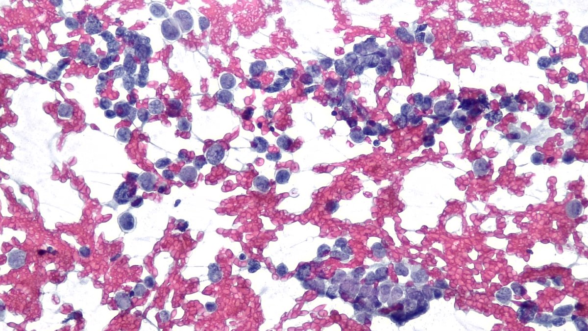 mdlozanoe's tweet photo. An awesome case to start 2025
71M, retroperitoneal mass/adenopathy. No other lesions.
Round cells of intermediate size, 
Scant cytoplasm, 
Clumped chromatin, 
Very isolated nucleoli, mitosis.
What do you think? 🤔🤔
@SECitologia @IACytology @CytologyEFCS @aakasharmand   @mtsiddi https://t.co/IE7wlf68xW