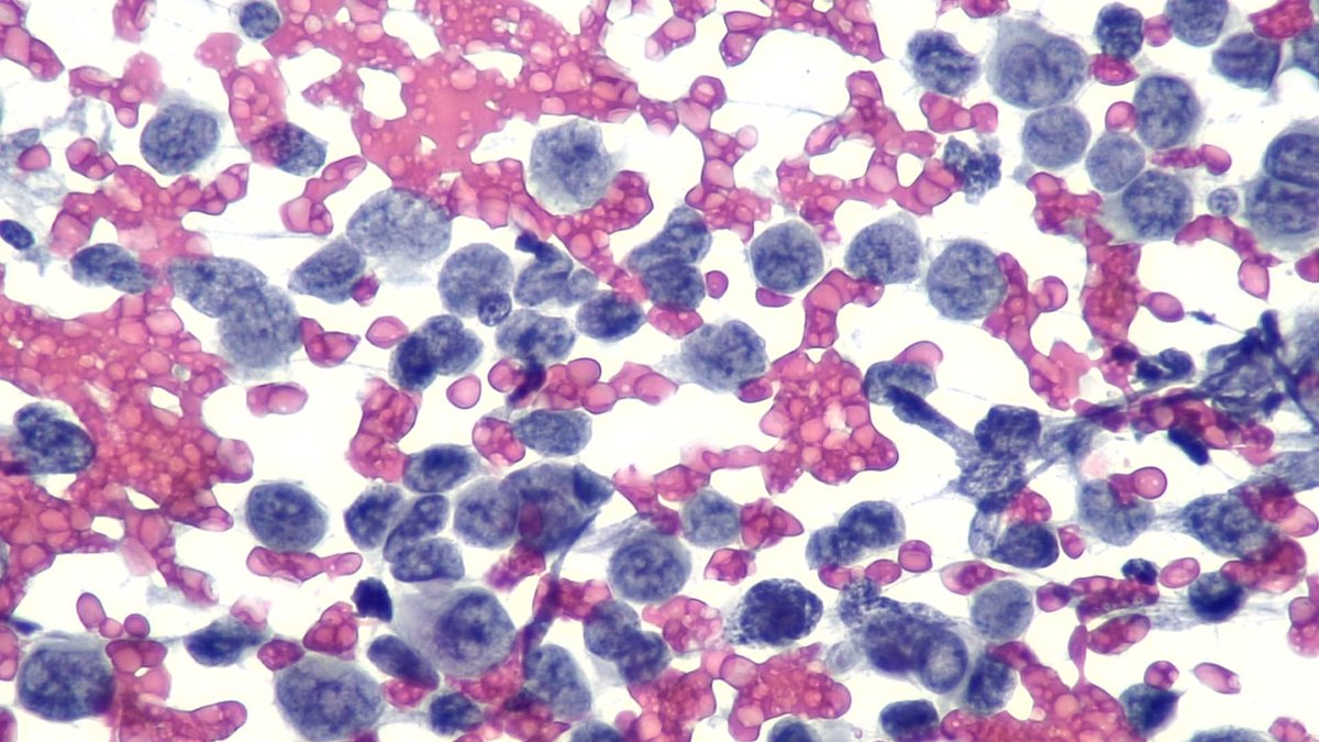 mdlozanoe's tweet photo. An awesome case to start 2025
71M, retroperitoneal mass/adenopathy. No other lesions.
Round cells of intermediate size, 
Scant cytoplasm, 
Clumped chromatin, 
Very isolated nucleoli, mitosis.
What do you think? 🤔🤔
@SECitologia @IACytology @CytologyEFCS @aakasharmand   @mtsiddi https://t.co/IE7wlf68xW
