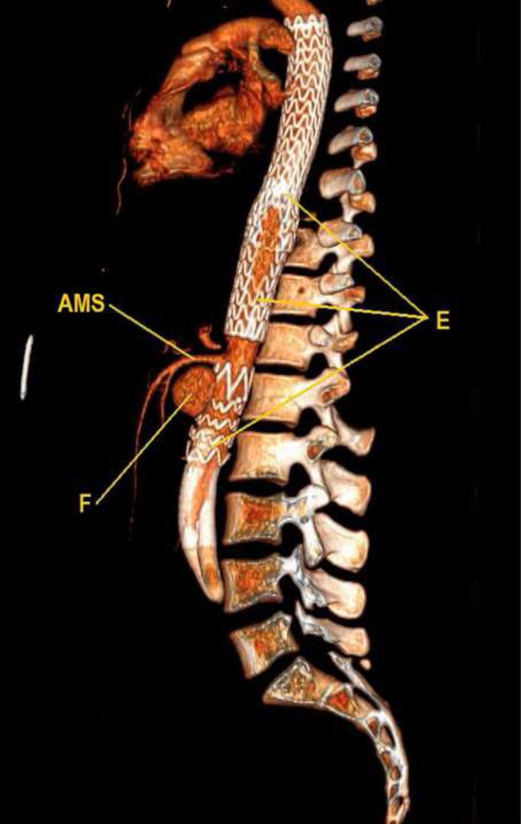 Síndrome de Ehlers-Danlos tipo vascular: un reto terapéutico. elsevier.es/es-revista-med…