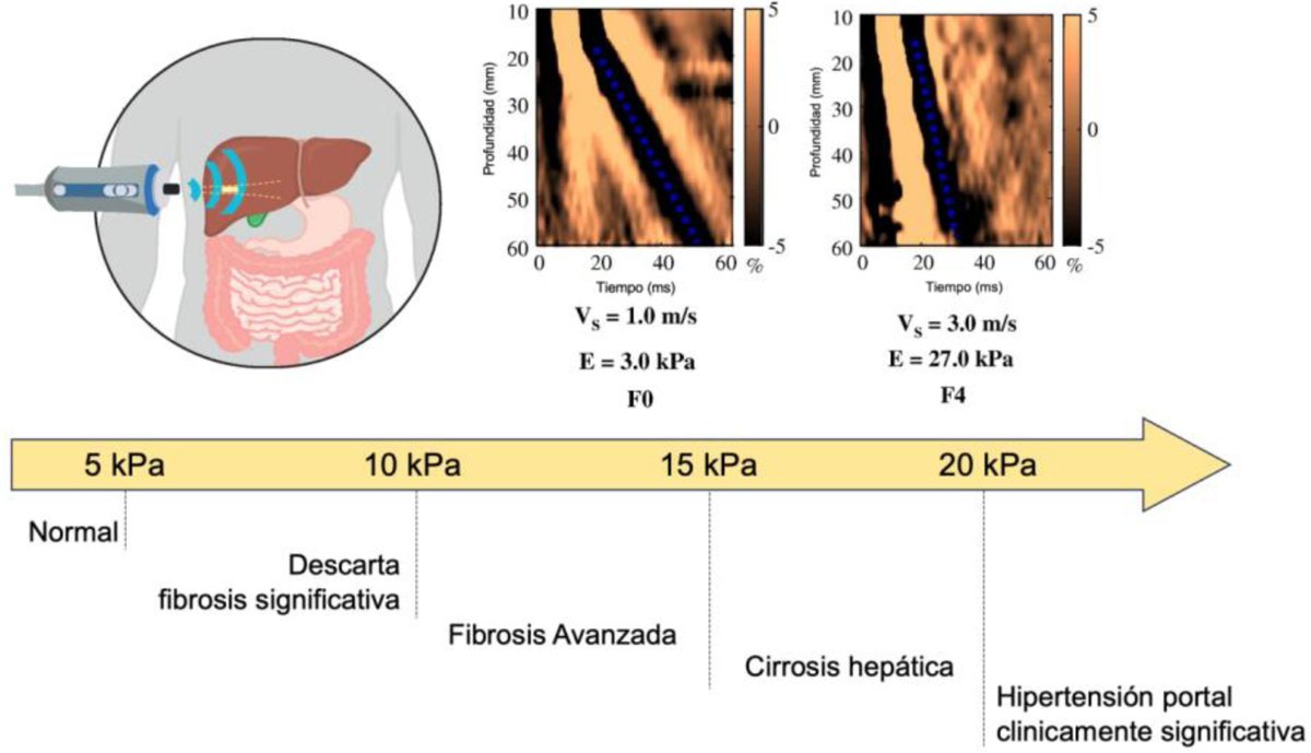 Cirrosis hepática: enfermedad antigua, reto nuevo. elsevier.es/es-revista-med…
