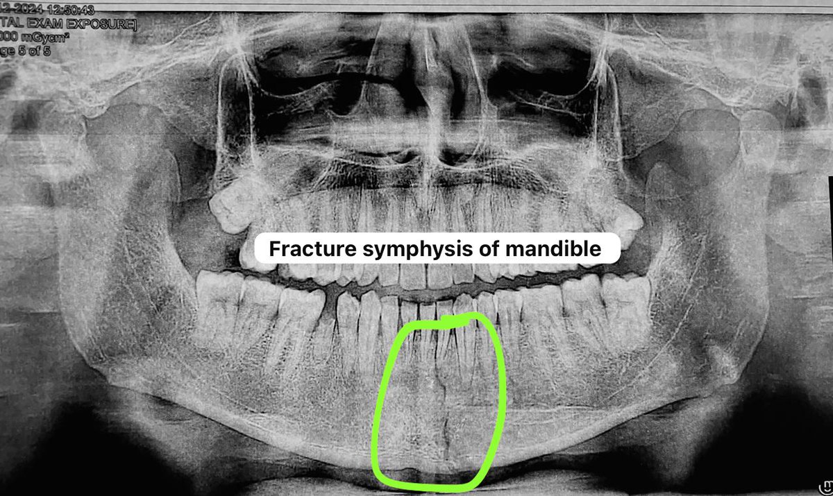 Medical Education Uttar Pradesh (@meupgovt) on Twitter photo A successful start to 2025, the team at Government Medical College Jalaun (Orai), UP, successfully operated on the first case of the year: a fractured mandible symphysis. Another case involving a fractured mandible in the angle region is scheduled for surgery.
#MeUP A successful start to 2025, the team at Government Medical College Jalaun (Orai), UP, successfully operated on the first case of the year: a fractured mandible symphysis. Another case involving a fractured mandible in the angle region is scheduled for surgery.
#MeUP