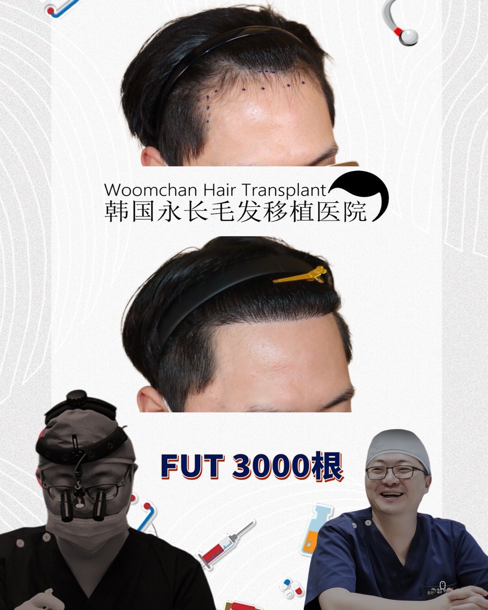 lee910907's tweet photo. FUT3000根加密髮際線
FUT3000 Hairs after 8months
微信👉woomchan 
line👉woomchan88
whatsapp: +821097895827
https://t.co/IWnWgwD2kc
 #韓國免剃髮植髮 #永長植髮 #woomchan永長植髮 #韩国植发医院 #韩国植髮費用 #切開式植髮 #hairtransplantsurgery #韓國免剃发植发 #FUE免剃发植 #韓國植髮 https://t.co/PEdjemA9wz
