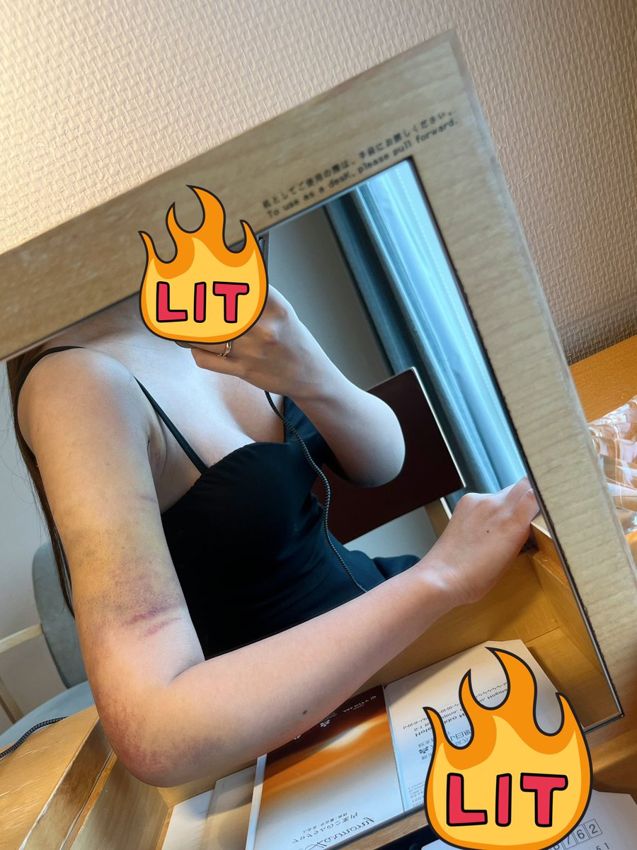 nyaoha_22's tweet photo. 二の腕脂肪吸引 DT4日目📸

痣が黄色くなってきた
肘近辺が腫れと痣激しめ🩹
肌見せできないのと、手術前より太いくらい腫れてるからタイトなトップスはまだむりでした

痛いけど耐えたら横向きで寝られた🤗 https://t.co/R5oz79Kpyu