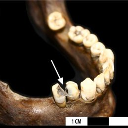 Dr Sarah Inskip (@sarahainskip) on Twitter photo 🦷🚨Are you into teeth? Here is the <a href="/TobacHistory/">TobaccoHealthHistory</a> projects latest work on an index for assessing oral health in the past. sciencedirect.com/.../pii/S18799… Congrats @DrDaviesB for leading this, and <a href="/NickJakubovics/">Nick Jakubovics</a> and <a href="/DrRichHolliday/">Richard Holliday</a> for their contributions! 🦷🚨Are you into teeth? Here is the <a href="/TobacHistory/">TobaccoHealthHistory</a> projects latest work on an index for assessing oral health in the past. sciencedirect.com/.../pii/S18799… Congrats @DrDaviesB for leading this, and <a href="/NickJakubovics/">Nick Jakubovics</a> and <a href="/DrRichHolliday/">Richard Holliday</a> for their contributions!