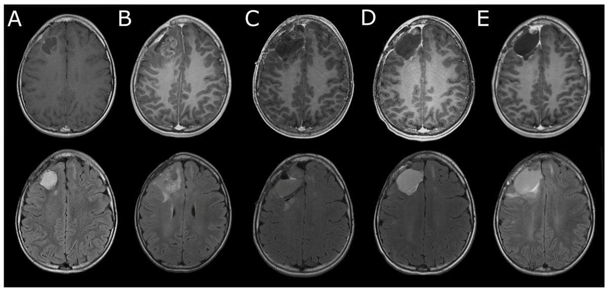 😃 Check out #casereport: Intratumoral/Peritumoral Herpes Simplex Virus-1 Mutant HSV1716 in Pediatric Patients with Refractory or Recurrent High-Grade Gliomas #Gliomas
<a href="/MDPIOpenAccess/">MDPI</a>  <a href="/MdpiOnco/">Onco_MDPI</a> 
👏 Authors: Aaron Y. Mochizuki et al
👉 mdpi.com/2673-7523/5/1/1