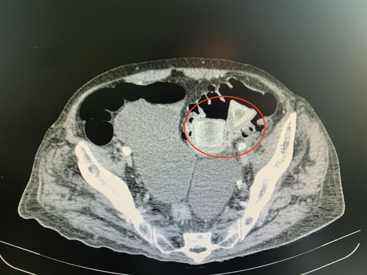 Íleo biliar por fístula colecistocólica con colon transverso. elsevier.es/es-revista-gas…