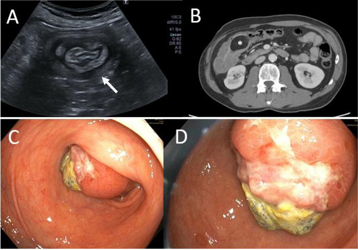 Invaginación intestinal secundaria a lipoma de colon: una causa infrecuente de hemorragia digestiva. elsevier.es/es-revista-med…
