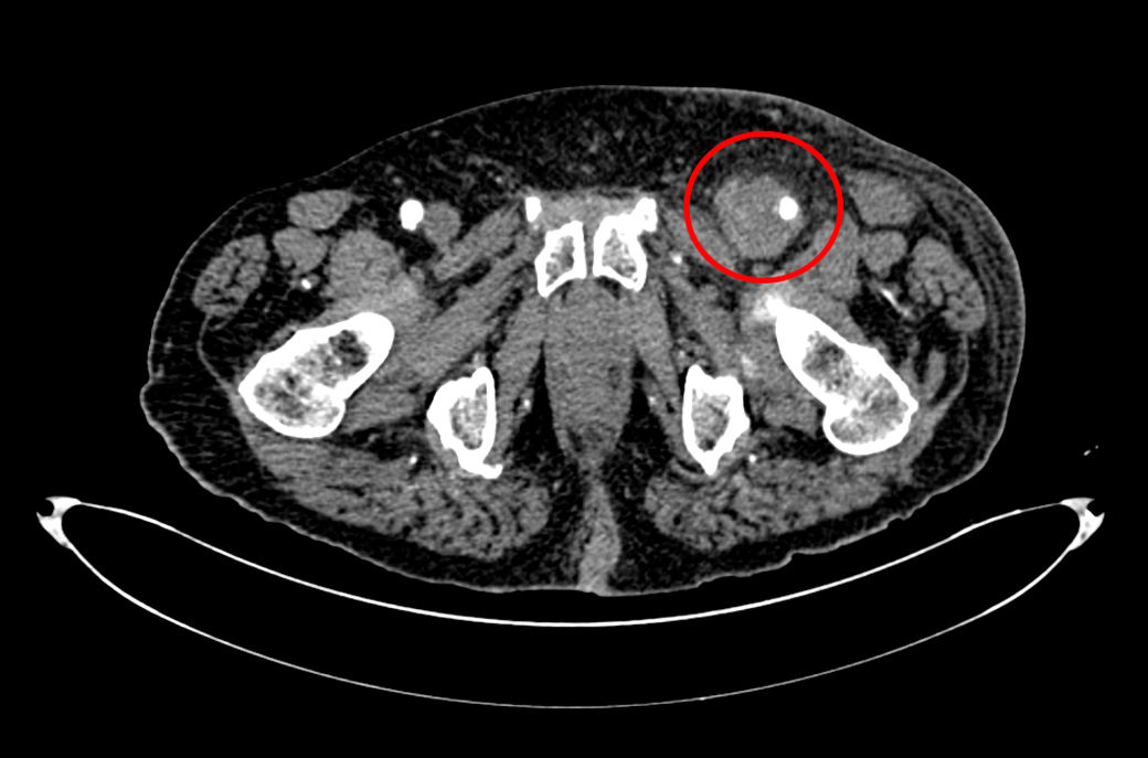 Aneurisma micótico, una complicación infrecuente del tratamiento del carcinoma urotelial. elsevier.es/es-revista-med…
