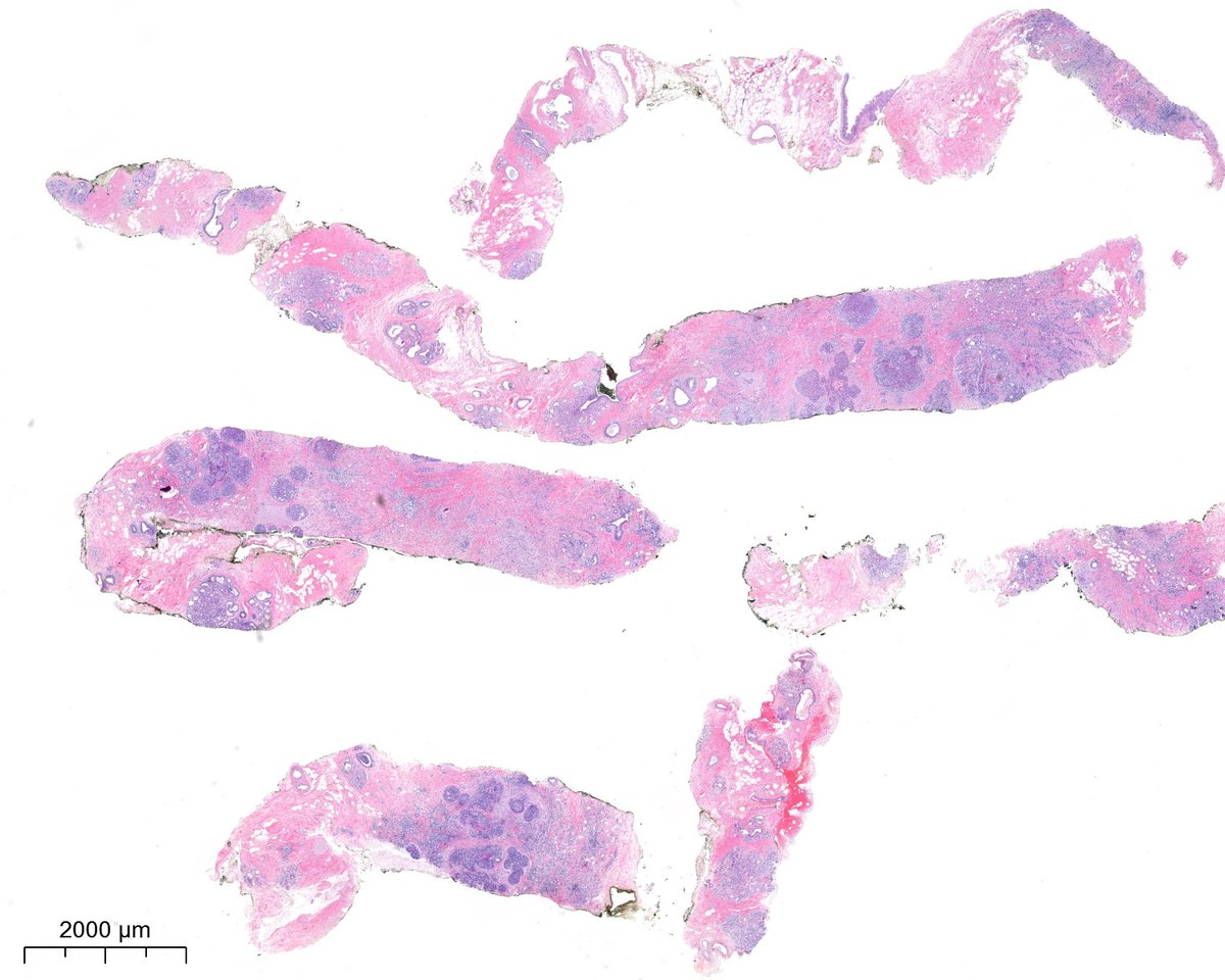 PoloniaAntonio's tweet image. F, 40s, breast nodule. @atman_ci @DrGeeONE @fouad_boulos @RazaHoda @ADamronMD @Teclis82 @LizaMQuintana @tlabiano @A_Morini_MD @ariella8 @surgpathlahore @amalasar86 @TristanRutland7 @israhkhan @kis_lorand @padmapathology1 @DrBMcGinn @Histopatolomon @Drmerm @kriyer68 #breastpath
