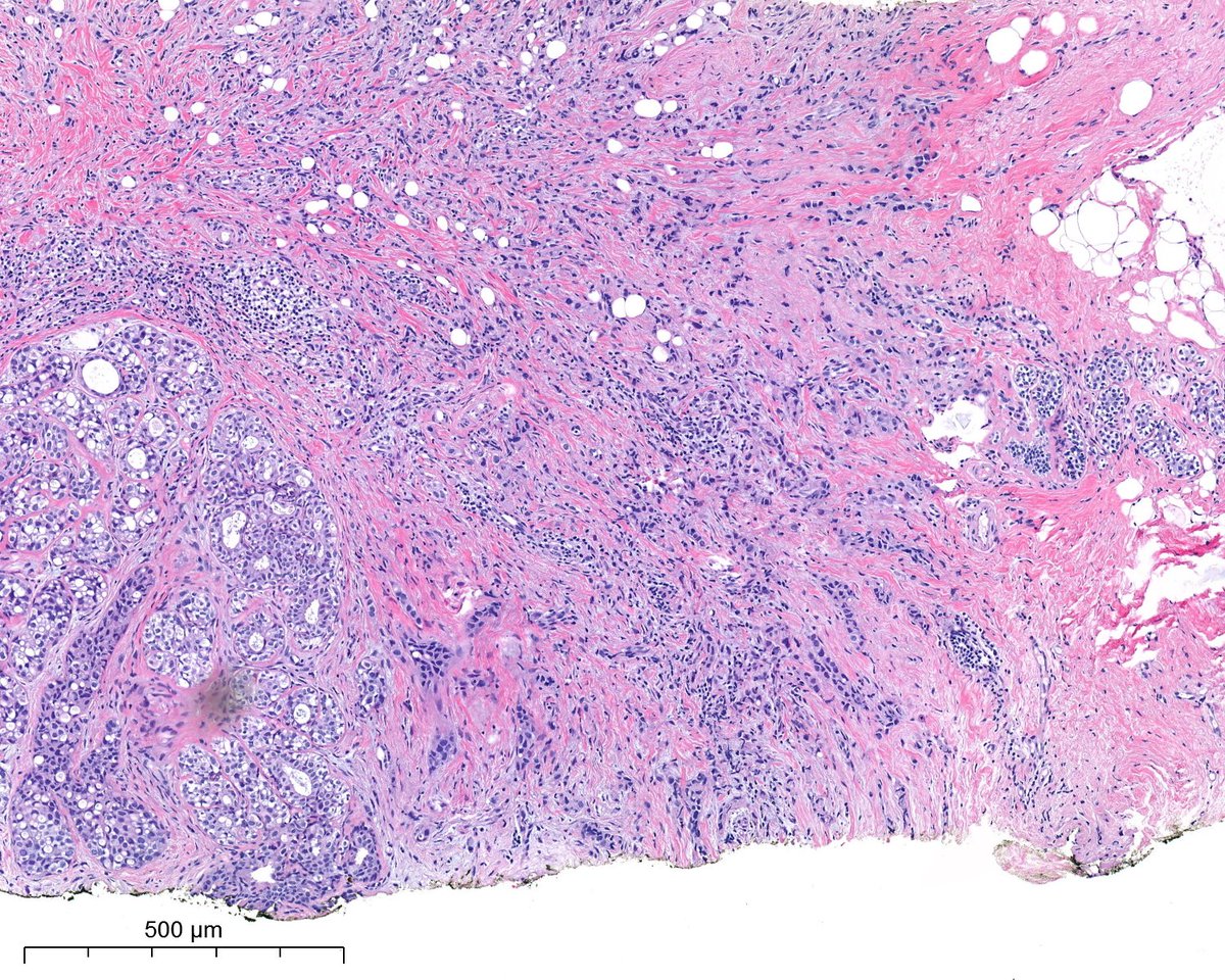 PoloniaAntonio's tweet image. F, 40s, breast nodule. @atman_ci @DrGeeONE @fouad_boulos @RazaHoda @ADamronMD @Teclis82 @LizaMQuintana @tlabiano @A_Morini_MD @ariella8 @surgpathlahore @amalasar86 @TristanRutland7 @israhkhan @kis_lorand @padmapathology1 @DrBMcGinn @Histopatolomon @Drmerm @kriyer68 #breastpath