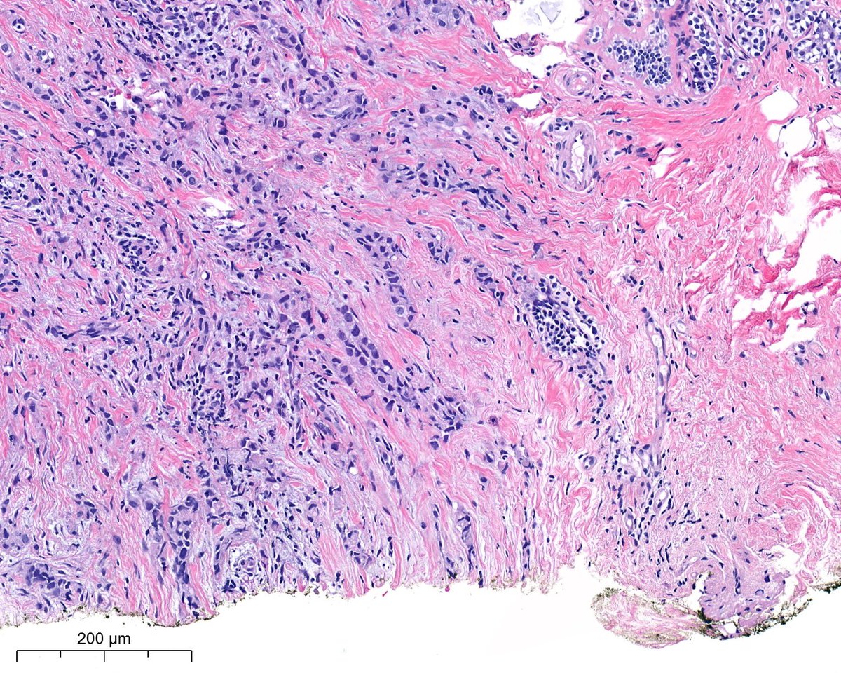 PoloniaAntonio's tweet image. F, 40s, breast nodule. @atman_ci @DrGeeONE @fouad_boulos @RazaHoda @ADamronMD @Teclis82 @LizaMQuintana @tlabiano @A_Morini_MD @ariella8 @surgpathlahore @amalasar86 @TristanRutland7 @israhkhan @kis_lorand @padmapathology1 @DrBMcGinn @Histopatolomon @Drmerm @kriyer68 #breastpath