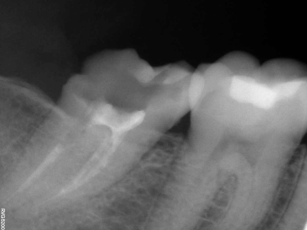 dentist_amar617's tweet image. Root canal retreatment  of lower 2nd molar 
Followed by fiber post plasment 
#saveatooth #endodonticslife #آيبريسيز_كلنك