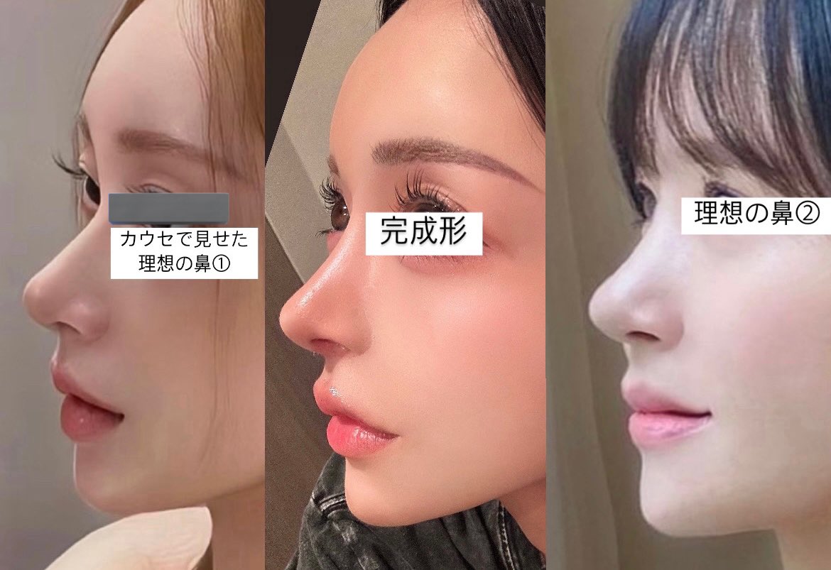 tequila_yamero's tweet photo. 私は再手術のときに

・鼻筋が直線すぎるのでカーブが欲しい
・尖り気味の鼻先にちょっと丸みが欲しい、三角形→五角形の鼻にしたい
・矢印鼻にならない&中顔面が間延びしない程度に鼻柱を出したい

↑この3点を伝えたよ🥺
前の鼻よりナチュラルになったって言われるようになって嬉しい🫶🏻

ビフォアフ見れなくなってるからもう一回載せる！
このときは術後2ヶ月ぐらいなのでまだ全然腫れてる