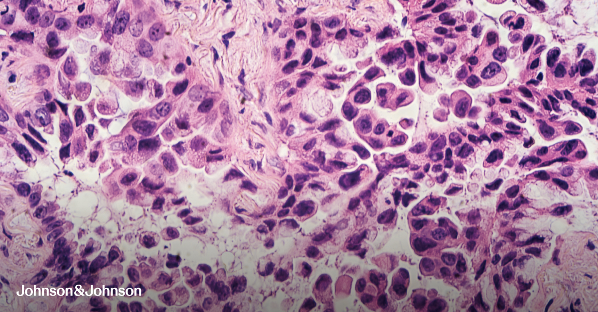 Joshua Bauml, MD (@jbauml) on Twitter photo Proud to share a topline overall survival announcement from the Phase 3 MARIPOSA trial in EGFR-mutated #NSCLC. These data reinforce <a href="/JNJInnovMed/">J&J Innovative Medicine</a>’s dedication to help transform what’s possible in cancer care and potentially give patients more time and hope: bit.ly/4a3Dwa9 Proud to share a topline overall survival announcement from the Phase 3 MARIPOSA trial in EGFR-mutated #NSCLC. These data reinforce <a href="/JNJInnovMed/">J&J Innovative Medicine</a>’s dedication to help transform what’s possible in cancer care and potentially give patients more time and hope: bit.ly/4a3Dwa9