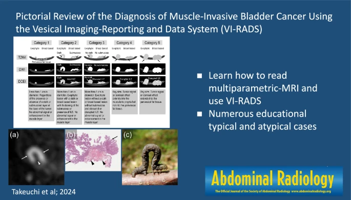 Abdominal Radiology (@abdominal_rad) on Twitter photo Pictorial review of the diagnosis of muscle-invasive bladder cancer using vesical imaging-reporting and data system (VI-RADS)
link.springer.com/article/10.100โฆ
Takeuchi M, et al.
#AbdRadJ
<a href="/RadGeek/">Neeraj Lalwani</a>
<a href="/LetDdiceFlyHigh/">Sandeep Arora</a> Pictorial review of the diagnosis of muscle-invasive bladder cancer using vesical imaging-reporting and data system (VI-RADS)
link.springer.com/article/10.100โฆ
Takeuchi M, et al.
#AbdRadJ
<a href="/RadGeek/">Neeraj Lalwani</a>
<a href="/LetDdiceFlyHigh/">Sandeep Arora</a>