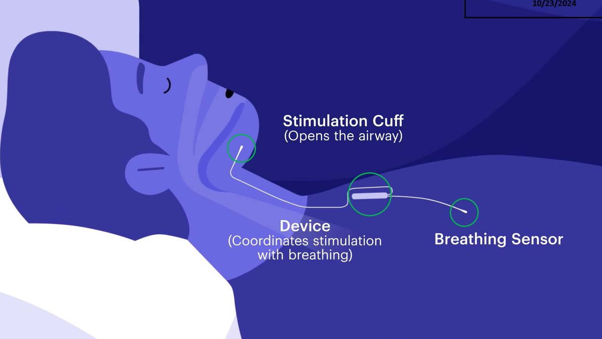 New research study on tongue pacemaker system to improve sleep apnea in people with #Downsyndrome, ages 10-21. More details at massgeneral.org/downsyndromere…