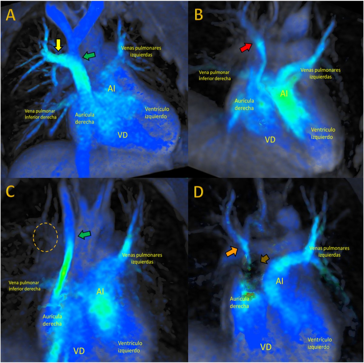 REC Publications (@revespcardiol) on Twitter photo Cardiorresonancia 4D-flow en drenaje venoso pulmonar anómalo intervenido #REC #AheadOfPrint <a href="/javierurmeneta1/">Javier Urmeneta</a> <a href="/jacabreracardio/">Dr. José Ángel Cabrera</a> revespcardiol.org/es-cardiorreso… Cardiorresonancia 4D-flow en drenaje venoso pulmonar anómalo intervenido #REC #AheadOfPrint <a href="/javierurmeneta1/">Javier Urmeneta</a> <a href="/jacabreracardio/">Dr. José Ángel Cabrera</a> revespcardiol.org/es-cardiorreso…