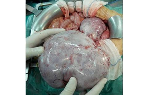 Med4Dummiess_'s tweet photo. 🔰 Cáncer de ovario 🔰

🔸 Mets + frecuente ➡️ Hígado 
🔸 Por diseminación linfática: 
     - Supraclavicular ➡️ Nódulo Virchow
     - Periumbilical ➡️ Nódulo hermana de Mary Joseph
     - Ovario ➡️ Tumor Krukemberg 
     - Paredes rectales ➡️ Tumor Blummer 

#ENARM 
#ENARM2025 https://t.co/ciZMysWUKg