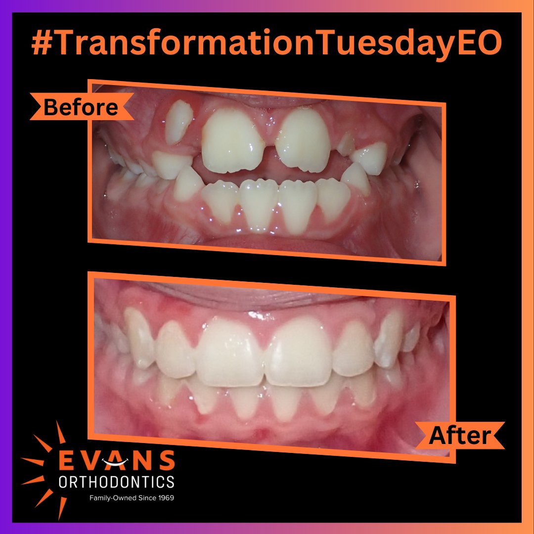 evansortho's tweet image. When the top teeth don't overlap the lower teeth, biting into pizza or a sandwich is tough.  #Wecanfixthat  Call today for a complementary consultation.   We'll have you on your way to a functioning bite and a beautiful smile! #Evansorthosmiles #openbite
