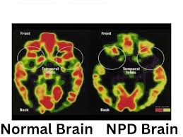 The brain on the left is a normal brain, the one on the right is the brain of a person with NPD. They have a severely decreases ability to store emotional memories, and their prefrontal cortex is damaged, which causes them to have problems with emotional regulation and