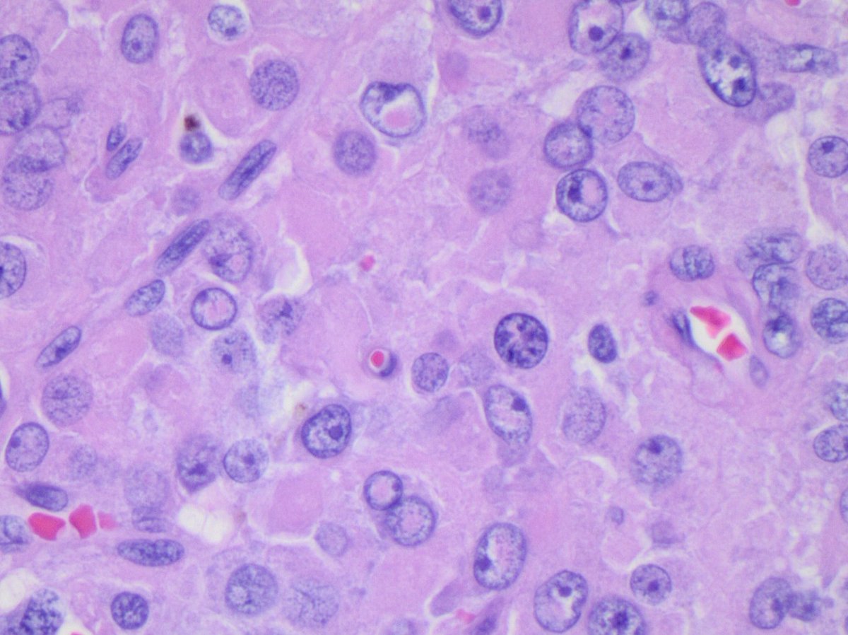 Leydig cell tumor 

Gorgeous intranuclear and cytoplasmic inclusions ~ Reinke crystals !

#GUpath