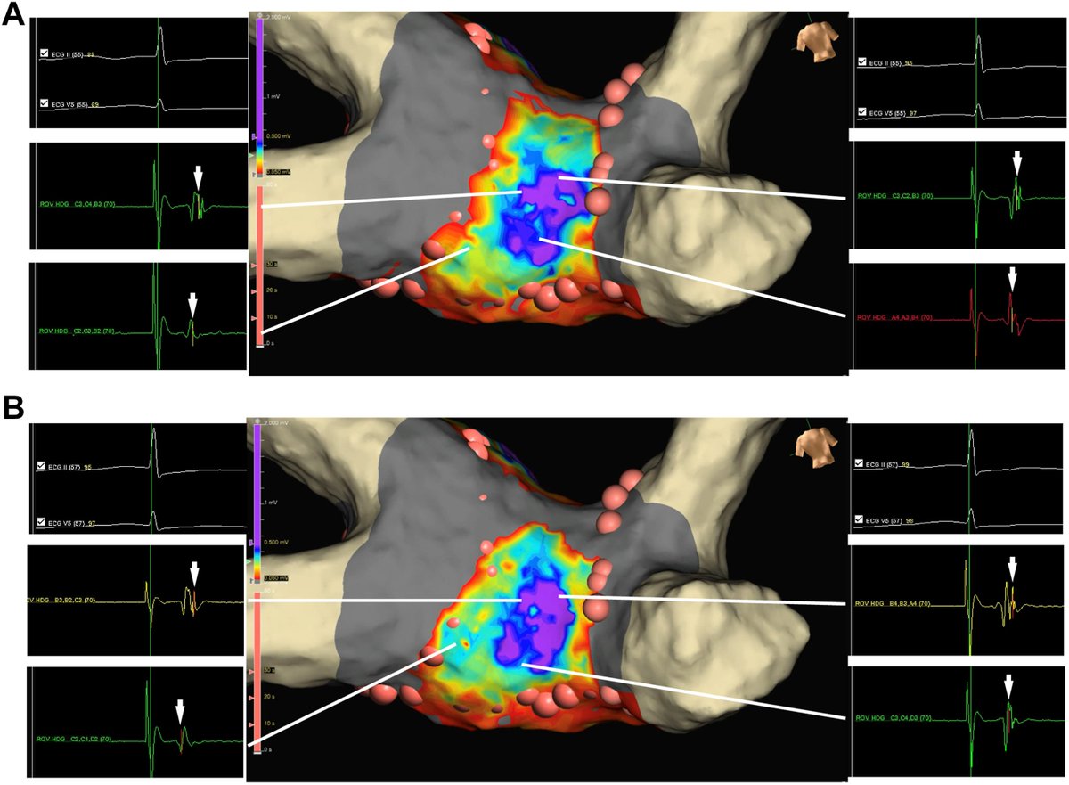 Differentiation between epicardial and endocardial conduction gaps for left atrial posterior wall isolation using peak frequency annotation algorithm
heartrhythmcasereports.com/article/S2214-…