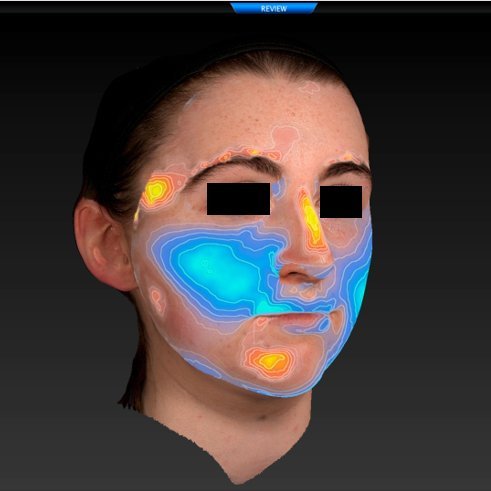 Are your mewing efforts working?

Could braces be damaging your face?

I've launched the Scan Me project to get 3D facial and dental scans (including parallax-free photos) at my London clinic for state-of-the-art records to monitor your face and teeth: orthodontic