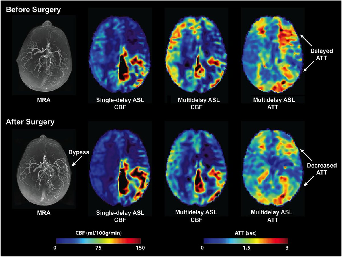 Moss Zhao, DPhil (@mosszhaodphil) on Twitter photo New Paper 🏁
We present the first use of ASL MRI to assess hemodynamics in pediatric Cerebral Proliferative Angiopathy for neurosurgery.
doi.org/10.1161/SVIN.1…
Co-authored with <a href="/brainpaparazzo/">Rui Duarte</a>
<a href="/AHAScience/">AHA Science</a> <a href="/StanfordChild/">Stanford Children's</a> <a href="/StanfordNsurg/">Stanford Neurosurgery</a>
<a href="/ResearchCpa/">CPA Research Foundation</a> <a href="/stanfordneuroi1/">stanfordneuroimaging</a> #TeamScience New Paper 🏁
We present the first use of ASL MRI to assess hemodynamics in pediatric Cerebral Proliferative Angiopathy for neurosurgery.
doi.org/10.1161/SVIN.1…
Co-authored with <a href="/brainpaparazzo/">Rui Duarte</a>
<a href="/AHAScience/">AHA Science</a> <a href="/StanfordChild/">Stanford Children's</a> <a href="/StanfordNsurg/">Stanford Neurosurgery</a>
<a href="/ResearchCpa/">CPA Research Foundation</a> <a href="/stanfordneuroi1/">stanfordneuroimaging</a> #TeamScience