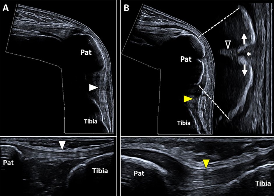 Sᴡɪss Uʟᴛʀᴀsᴏᴜɴᴅ Cᴇɴᴛᴇʀ - UZR (@rheumatology) on Twitter photo Ultrasound imaging of bone fractures
from <a href="/riccivincenzo17/">Vincenzo Ricci</a>
pmc.ncbi.nlm.nih.gov/articles/PMC97…
Ultrasound imaging is widely used to evaluate the neuromusculoskeletal system, and recently, a particular interest is mounting in assessing the bone tissue and fractures. Ultrasound can be Ultrasound imaging of bone fractures
from <a href="/riccivincenzo17/">Vincenzo Ricci</a>
pmc.ncbi.nlm.nih.gov/articles/PMC97…
Ultrasound imaging is widely used to evaluate the neuromusculoskeletal system, and recently, a particular interest is mounting in assessing the bone tissue and fractures. Ultrasound can be