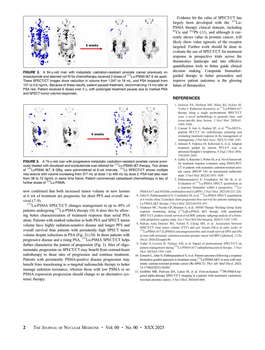 Michael Hofman (@drmhofman) on Twitter photo SPECT deserves RESPECT!
<a href="/drlouiseemmett/">Louise Emmett</a> makes the argument that it is a powerful tool for theranostics ➤ enabling early, personalised treatment response evaluation ➤ optimizes outcomes by guiding therapy adjustments.
✓practical advantages over serial PET. SPECT deserves RESPECT!
<a href="/drlouiseemmett/">Louise Emmett</a> makes the argument that it is a powerful tool for theranostics ➤ enabling early, personalised treatment response evaluation ➤ optimizes outcomes by guiding therapy adjustments.
✓practical advantages over serial PET.