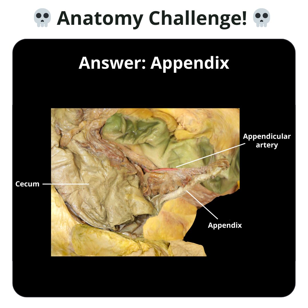 TeachMe_Support's tweet image. Anatomy challenge of the week 🏆 Can you name the structure? #quizyourself #meded #medschool #medicalstudent #medstudent #premed #premedlife #nursing #nursingschool #pastudent #physician #futuredoctor #studymotivation #medlife #surgery #medschoolmemes #medicalmeme  #medstudent