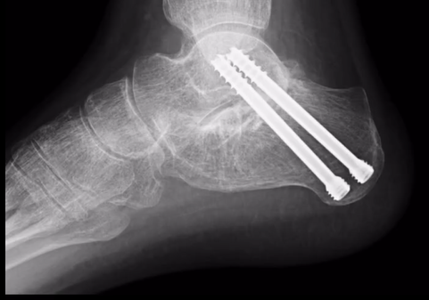 ClinicaCEMTRO (@clinicacemtro) on Twitter photo 💥¿Dolor tras fractura de calcáneo?
🔹 Cuando fisioterapia, ortesis, readaptación e infiltraciones no funcionan pasamos a la cirugía
👉 La artrodesis subtalar elimina el dolor artrósico diario y permite retomar actividades de impacto tras la fusión
🥼Vía <a href="/DrSergiohorte/">Dr. Sergio Hortelano</a> 💥¿Dolor tras fractura de calcáneo?
🔹 Cuando fisioterapia, ortesis, readaptación e infiltraciones no funcionan pasamos a la cirugía
👉 La artrodesis subtalar elimina el dolor artrósico diario y permite retomar actividades de impacto tras la fusión
🥼Vía <a href="/DrSergiohorte/">Dr. Sergio Hortelano</a>