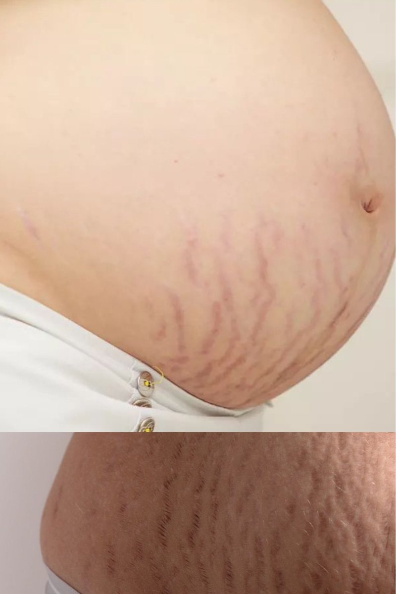 Bila kita gain weight or lose weight mendadak, akan ada strech mark yang muncul especially dekat peha, perut, betis &amp; lengan.

Lagi2 kalau pregnant 🥹

I nak share stretch mark cream yang berkesan untuk pudarkan stretch mark..