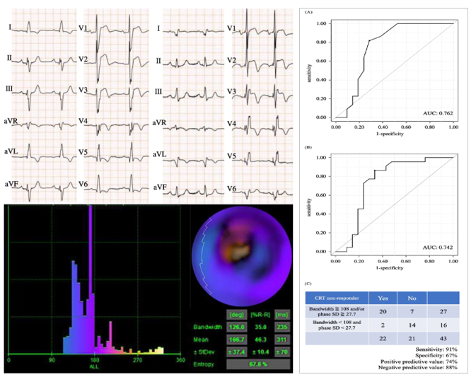 Latest #FreeRead Article in
<a href="/JICE_EP/">JICE</a>

Identifying Non-responders to Cardiac Resynchronization Therapy in the Non-Left Bundle Branch Block

🧐📖 rdcu.be/d5B4P

by Toshihiro Nakamura, <a href="/koi_koi_501/">Kohei Ishibashi</a>, Nobuhiko Useda, Satoshi Oka, Yuichiro Miyazaki, Akinori Wakamiya,