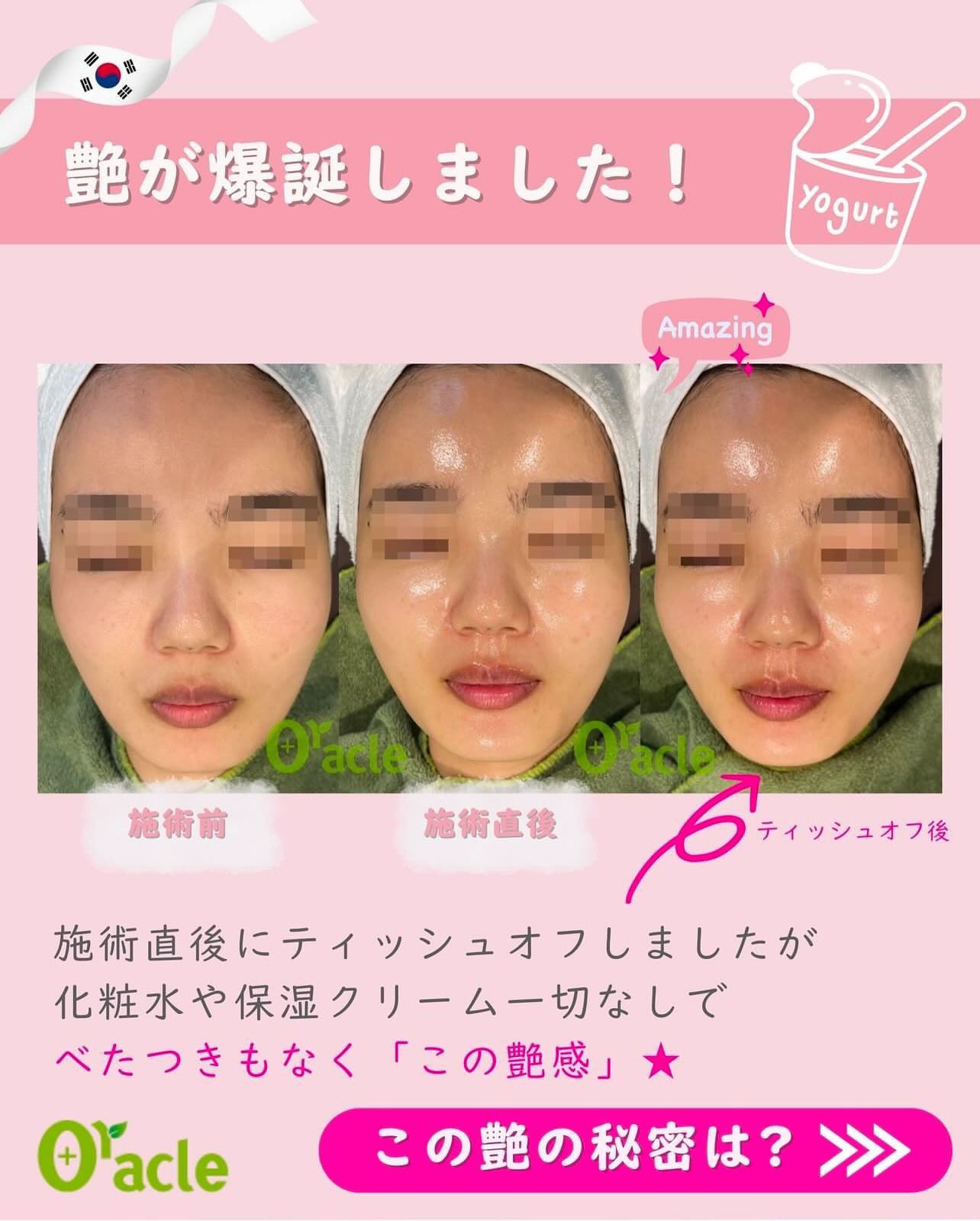 オラクル美容皮膚科【公式】 в X: „🇰🇷ヨーグルトピールが オラクル美容皮膚科【公式】 в X: „🇰🇷ヨーグルトピールが