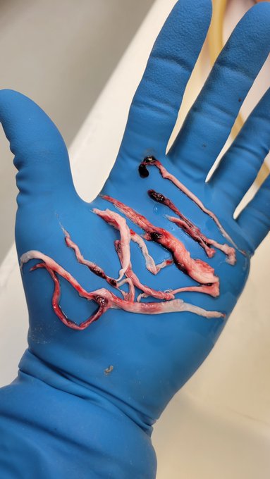 jazzman93063's tweet image. This is growing in ALL PEOPLE who took the BIOWEAPON DISQUISED AS A VACCINE,  AND CANNOT BE STOPPED !!!!🙏🙏