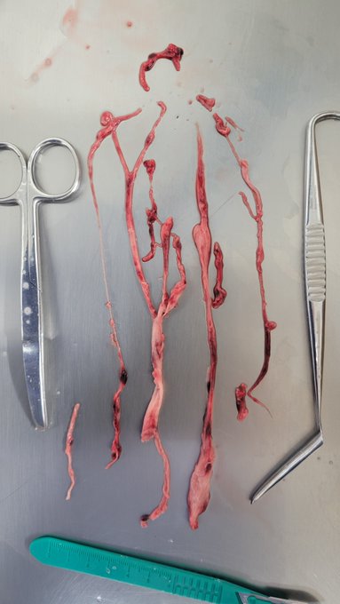 jazzman93063's tweet image. This is growing in ALL PEOPLE who took the BIOWEAPON DISQUISED AS A VACCINE,  AND CANNOT BE STOPPED !!!!🙏🙏